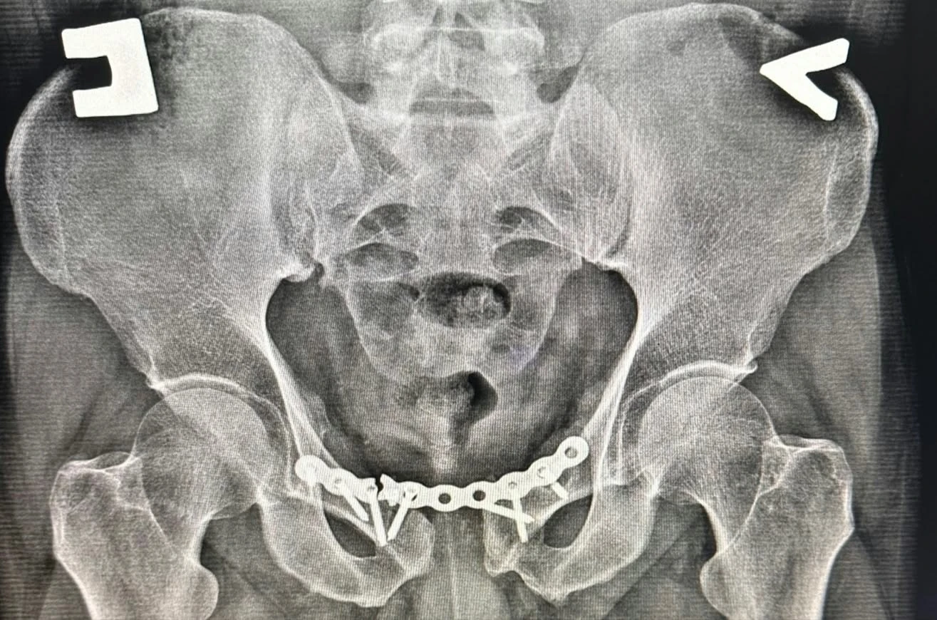 Pelvic X-ray showing Roman's pubic symphysis fixation hardware