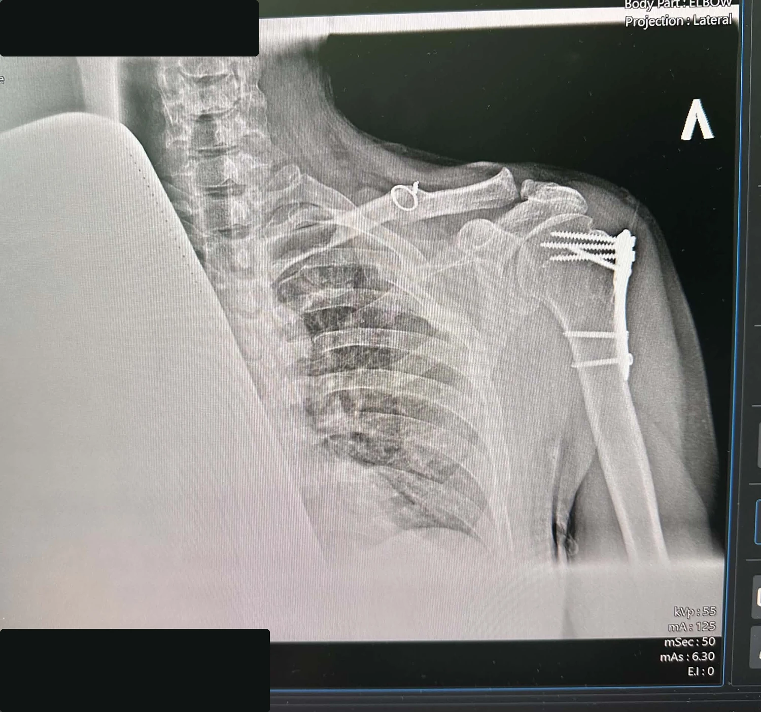 Redacted shoulder X-ray showing surgical hardware